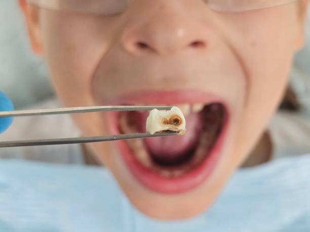 Best Emergency Treatment for Oral Infections in Piedmont, SD